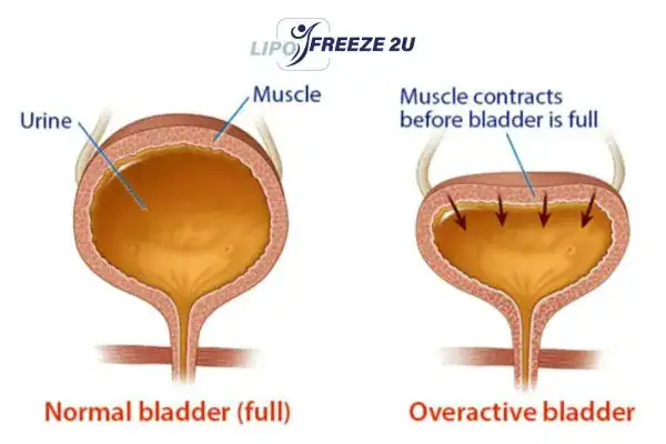 diagram of overactive bladder treatment Keighley