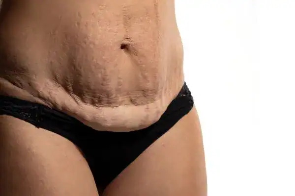 loose skin after weight loss injections Keighley