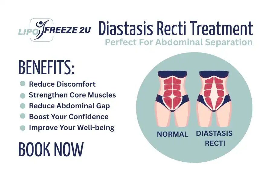 Benefits of body toning treatment Keighley for Diastasis recti