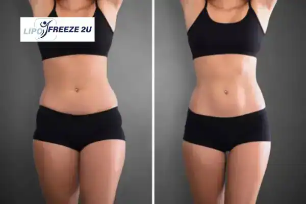 How Can LIPO FREEZE 2U Support Your Post-Pregnancy Body Recovery Keighley?