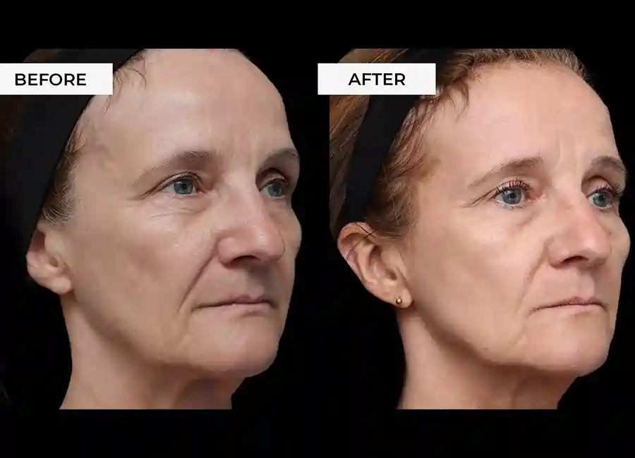 How Many RF Microneedling Sessions Will You Need to See a Difference Keighley?