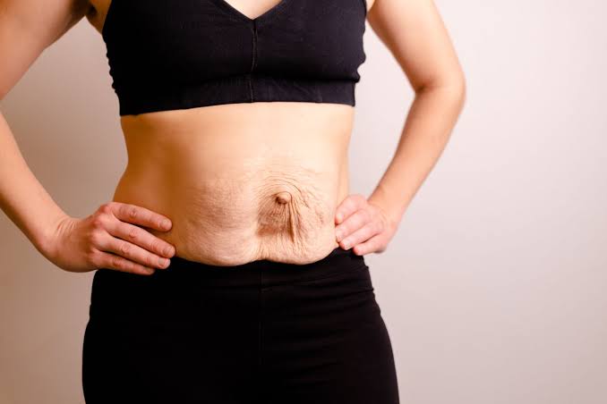 Is Surgery Really the Only Way to Repair Diastasis Recti Keighley?